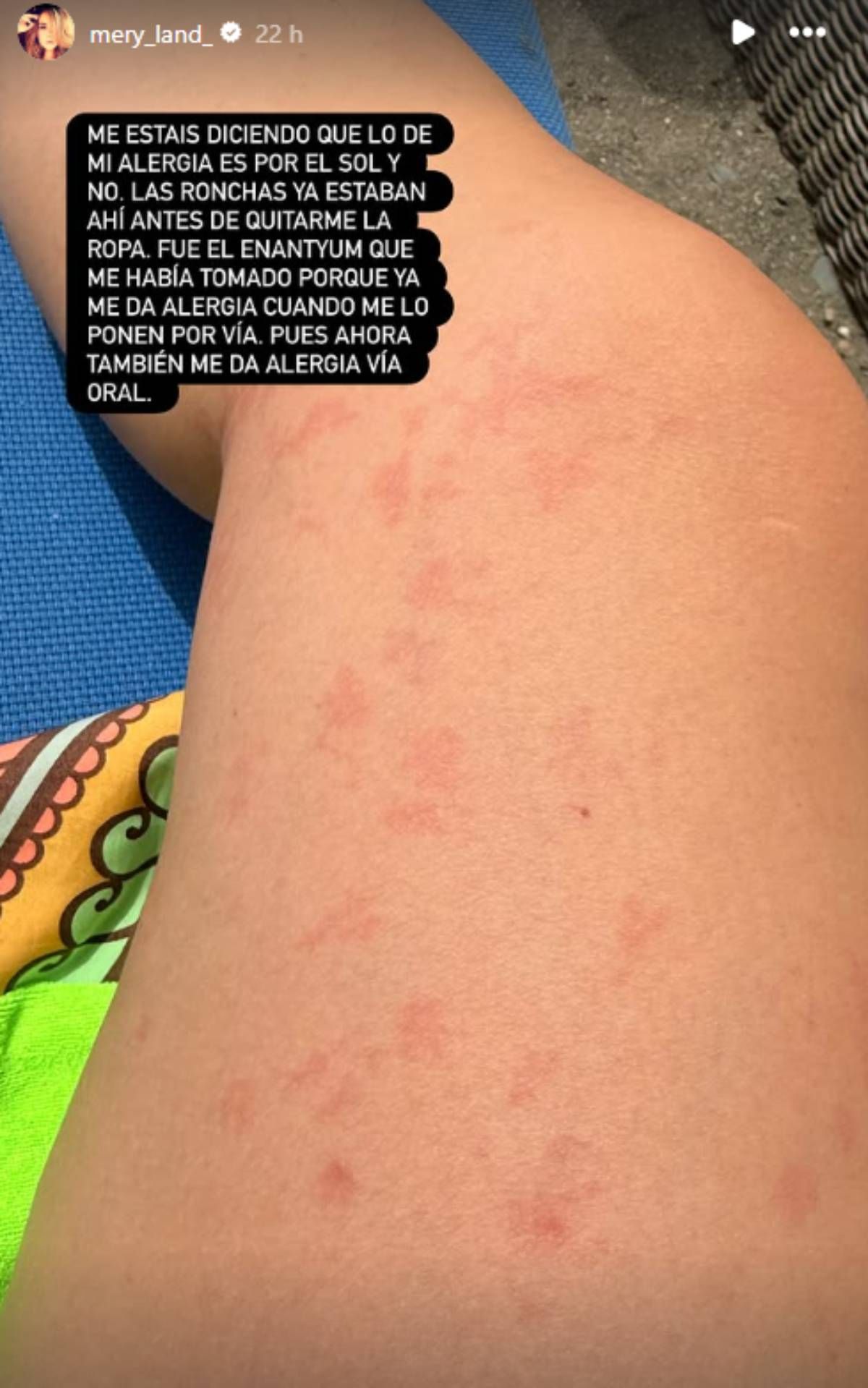 María José Campanario comparte las extrañas manchas que le han salido en la piel con sus seguidores