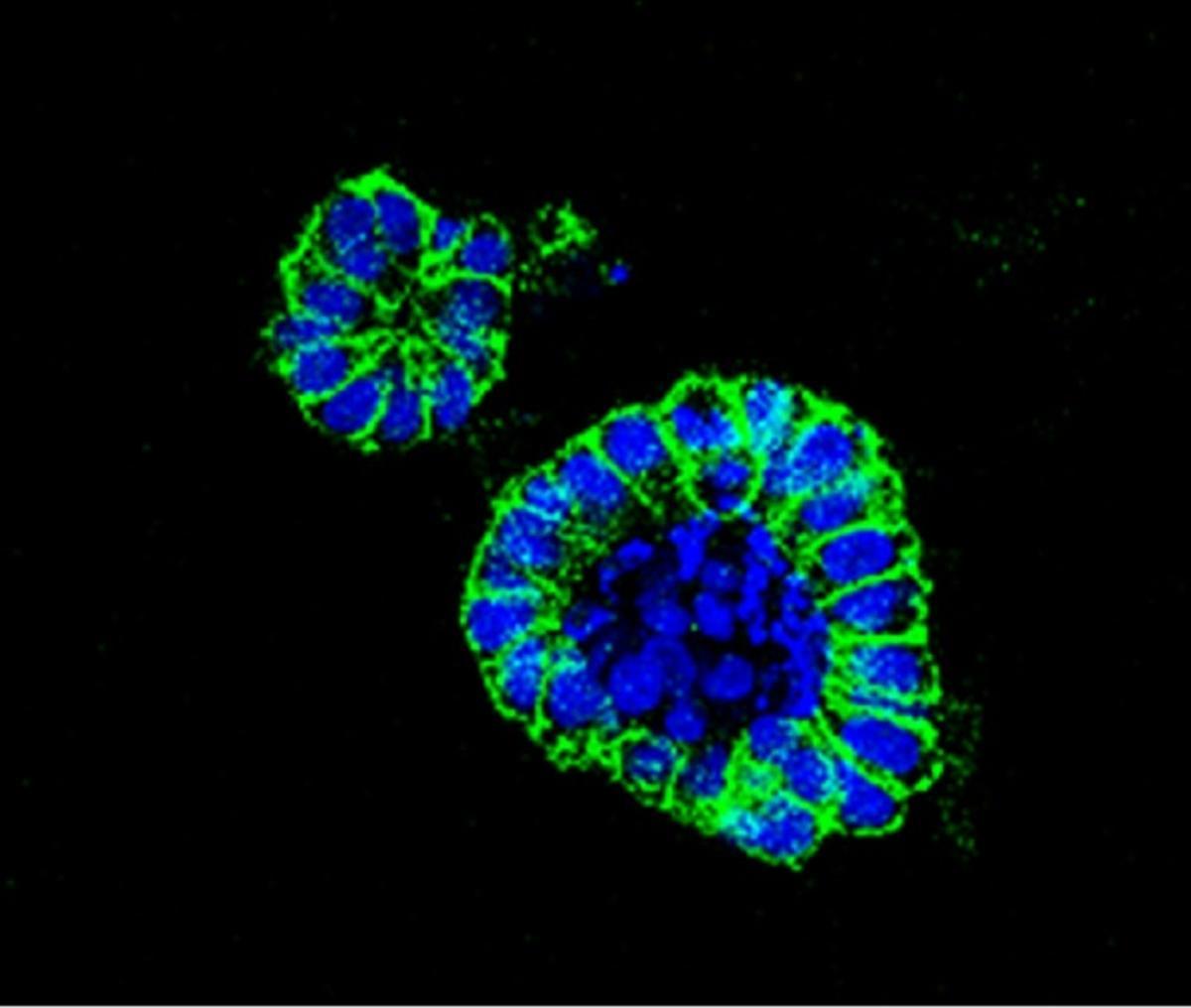 Organoide de cáncer de colon.