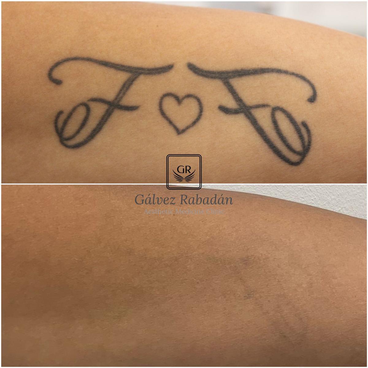 Antes y después de la eliminación de un tatuaje con láser realizado por el Dr. Gálvez.