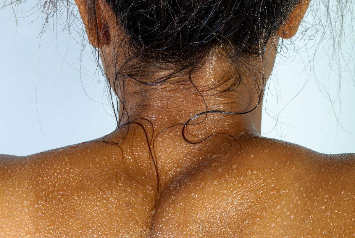 hidranderitis supurativa, una enfermedad complicada de manejar