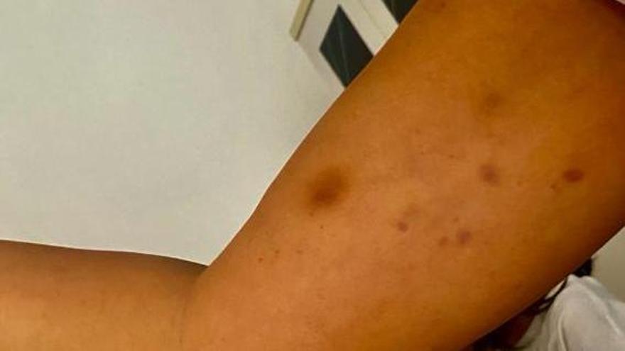 Hematomas que presentaba la madre tras la agresión.