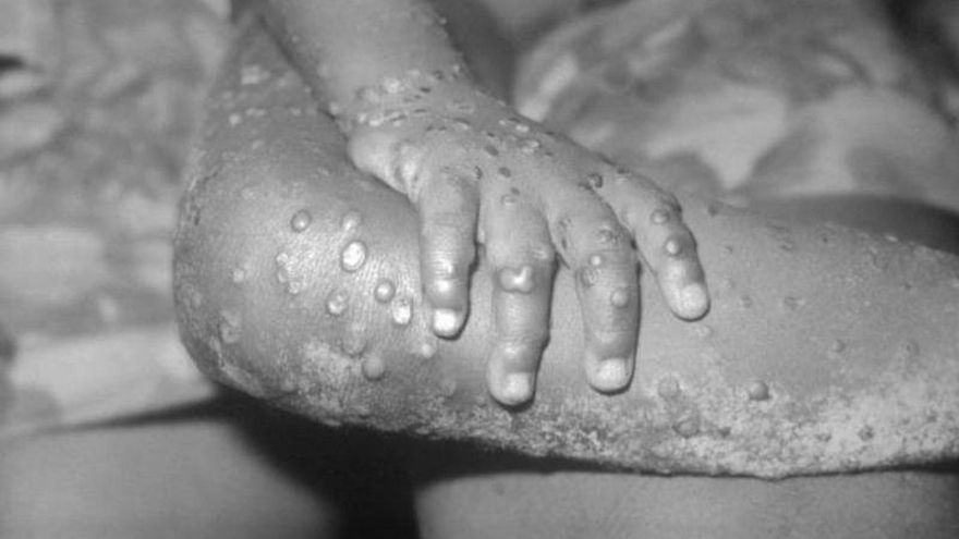 Viruela del Mono: ¿Cómo se transmite? ¿Cuáles son los síntomas?