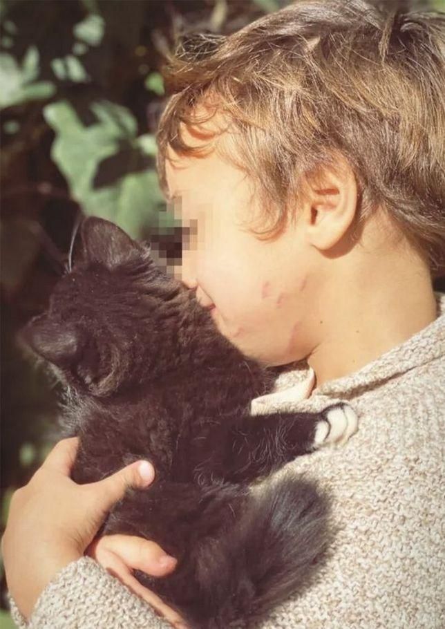 Cicatrices del ataque del puma al hijo de Raquel del Rosario