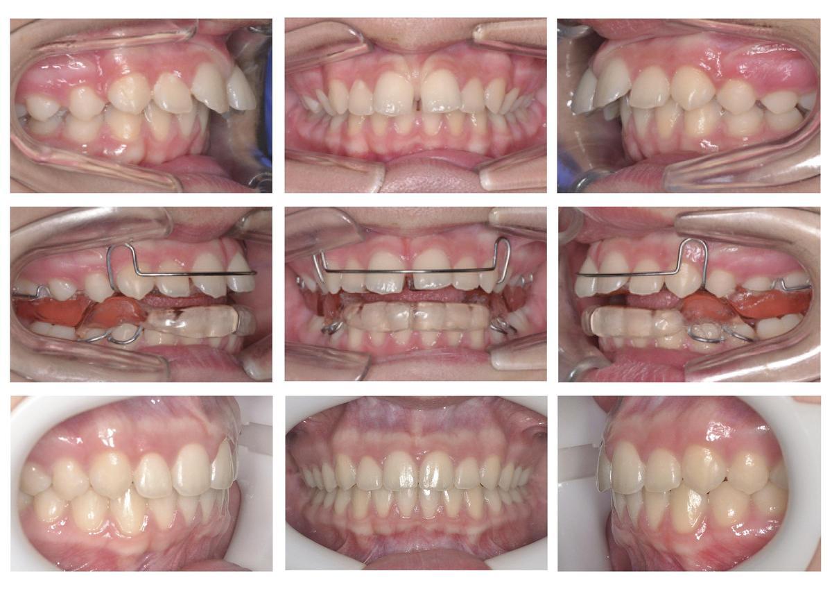 Evolución de un caso tratado en crecimiento con ortodoncia interceptiva y finalizado con aparatología fija multibrackets.