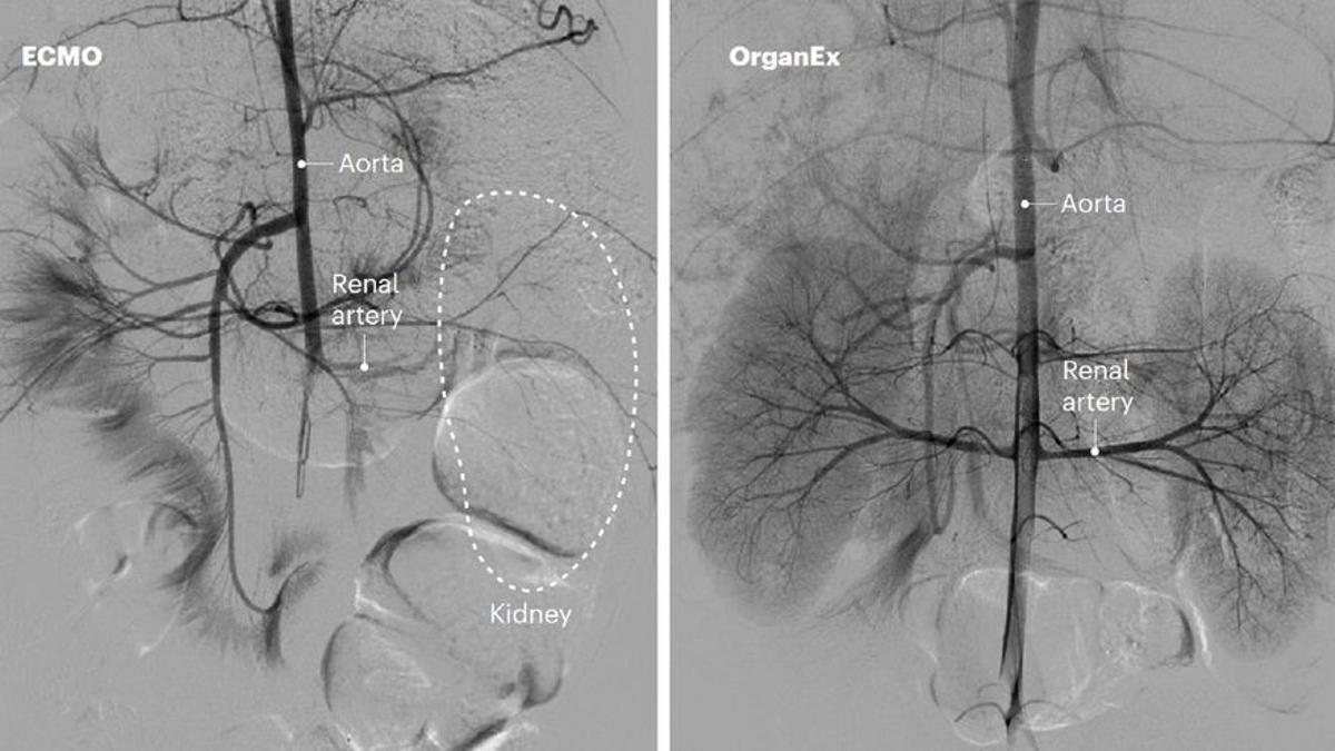 Comparativa entre un organismo tratado con ECMO y uno tratado con OrganEx. En el primero, se puede ver cómo el sistema no logra restablecer el flujo en todos los órganos. En el segundo, en cambio, se pusede ver que la sangre llega a más venas y arterias.