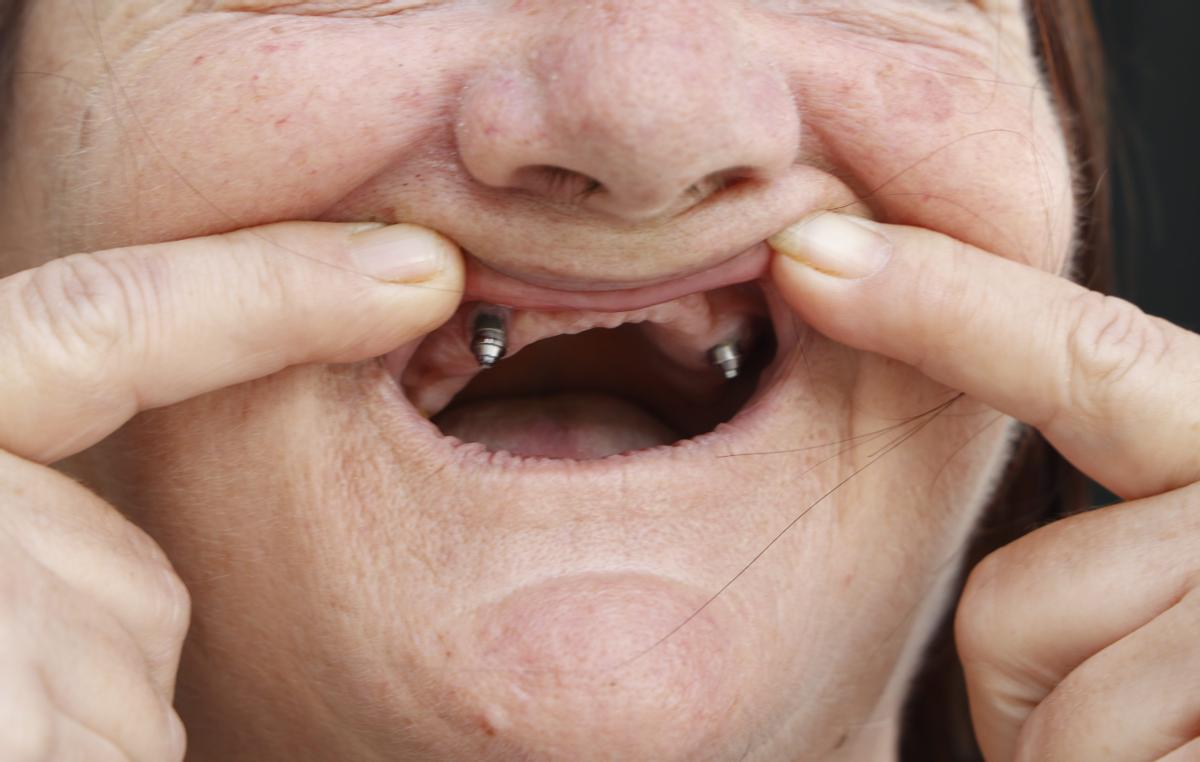 Rosa, afectada por la estafa de iDental, muestra su boca.