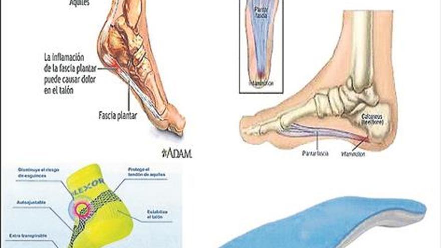 La fascitis plantar es una afección que se da en el tejido fibroso (fascia  plantar) a lo largo de la parte inferior del pie. 👉🏼 Puede…