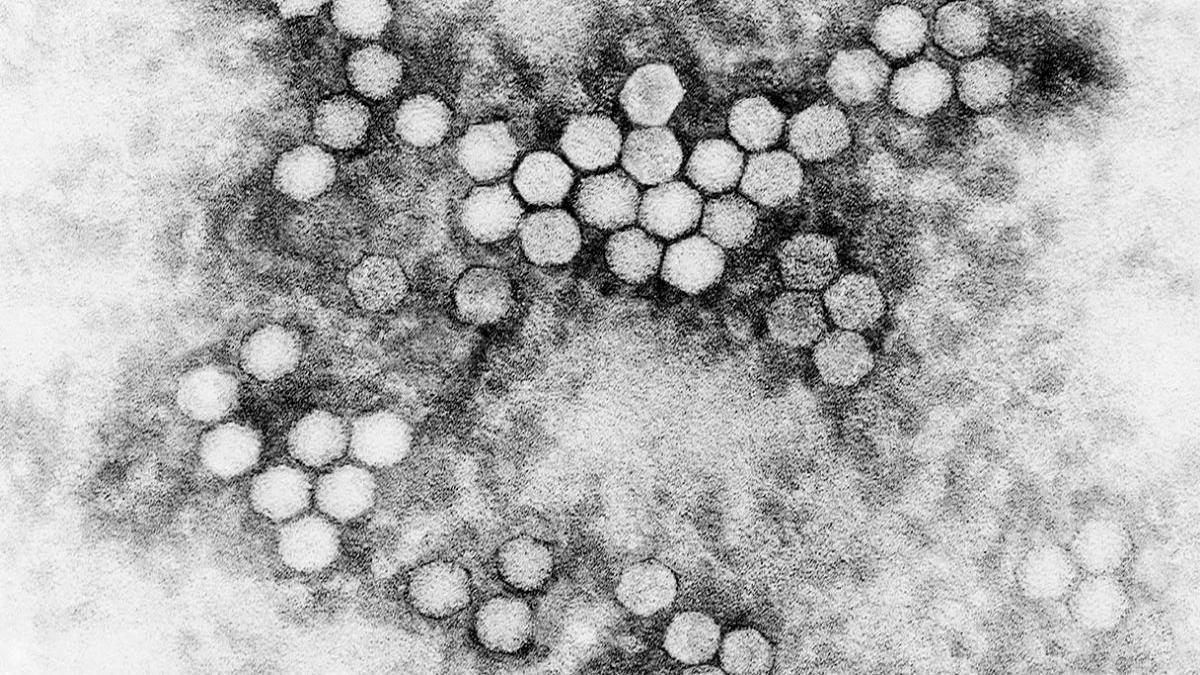 El poliovirus aparece esporádicamente en países declarados libres de la enfermedad cuando los viajeros introducen cepas derivadas de la vacuna.