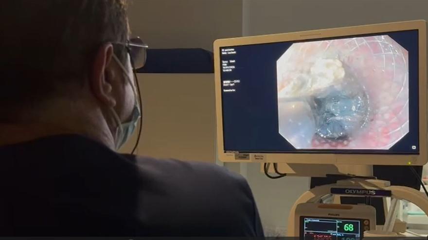 El Hospital del Vinalopó de Elche implanta una nueva técnica endoscópica para tratar la pancreatitis aguda