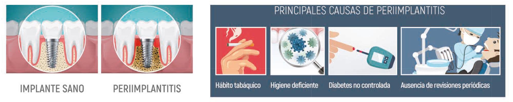 Principales causas de Perimplantitis.