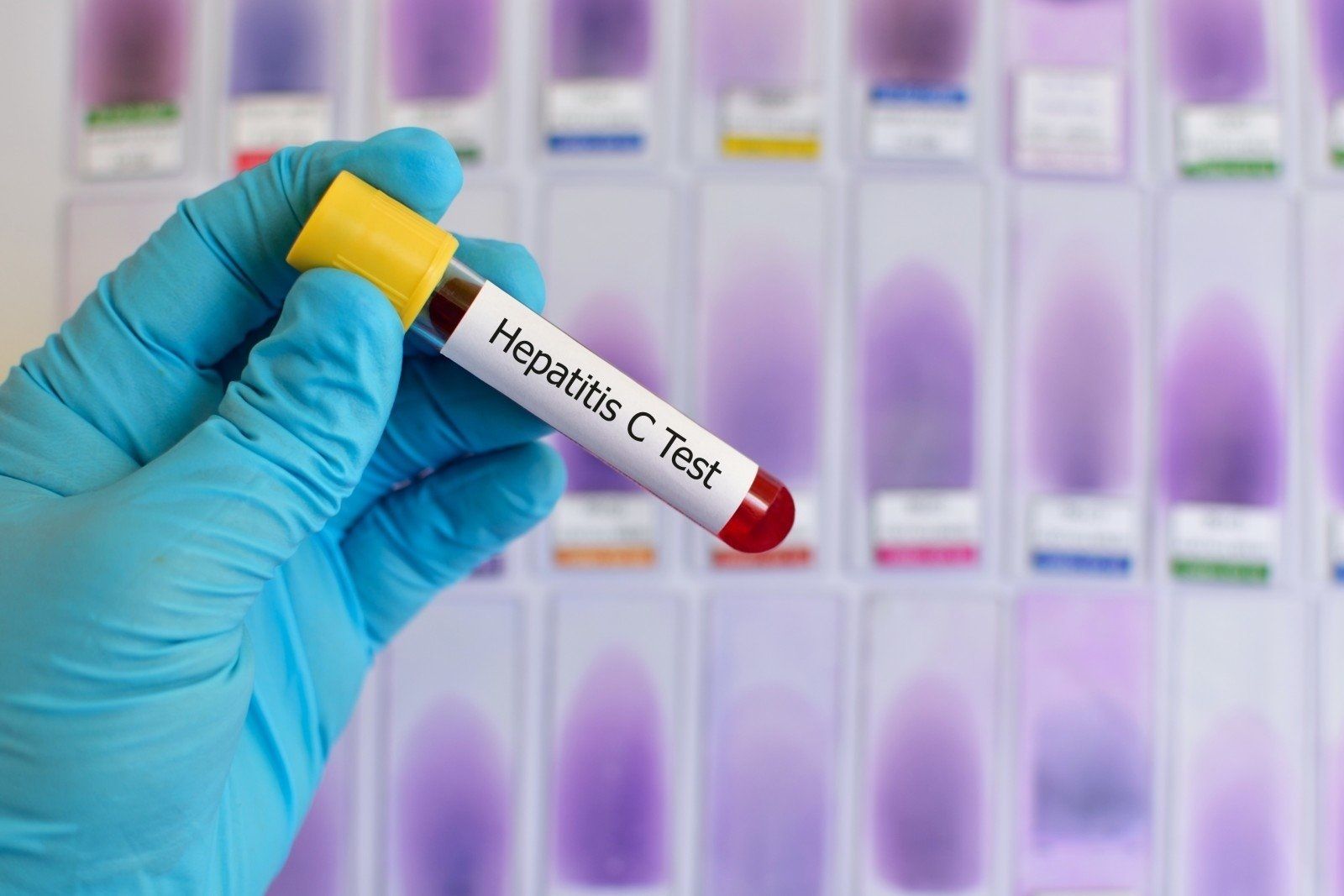 Pacientes hepatitis C sin tratar por colapso centros de salud en la sexta ola