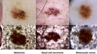 Investigadores de Alicante diseñan una herramienta con IA que detecta el melanoma con una precisión del 88 %