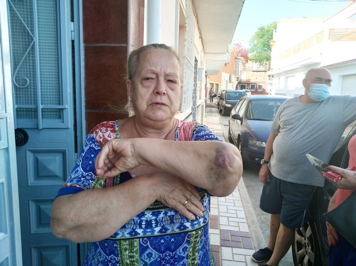 Rosario muestra cómo tiene el codo en la actualidad.