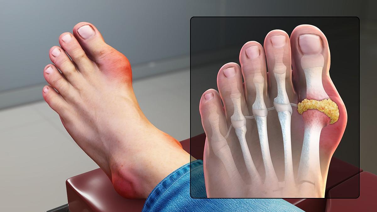 Ilustración en la que se ve un caso de gota:  hinchazón, rigidez y dolor alrededor en la articulación del pie.