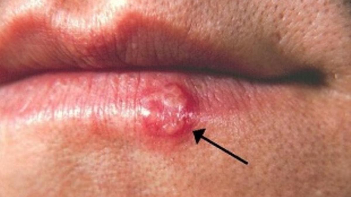 Herpes labial, causado por el virus simplex de tipo 1 (HSV-1)