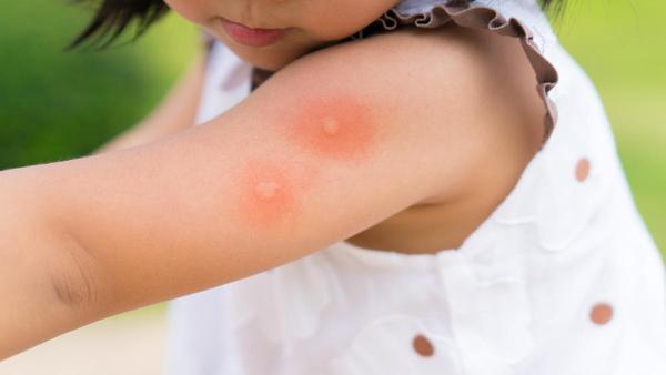PICADURAS MOSQUITOS: Remedios caseros para aliviar las picaduras de mosquito
