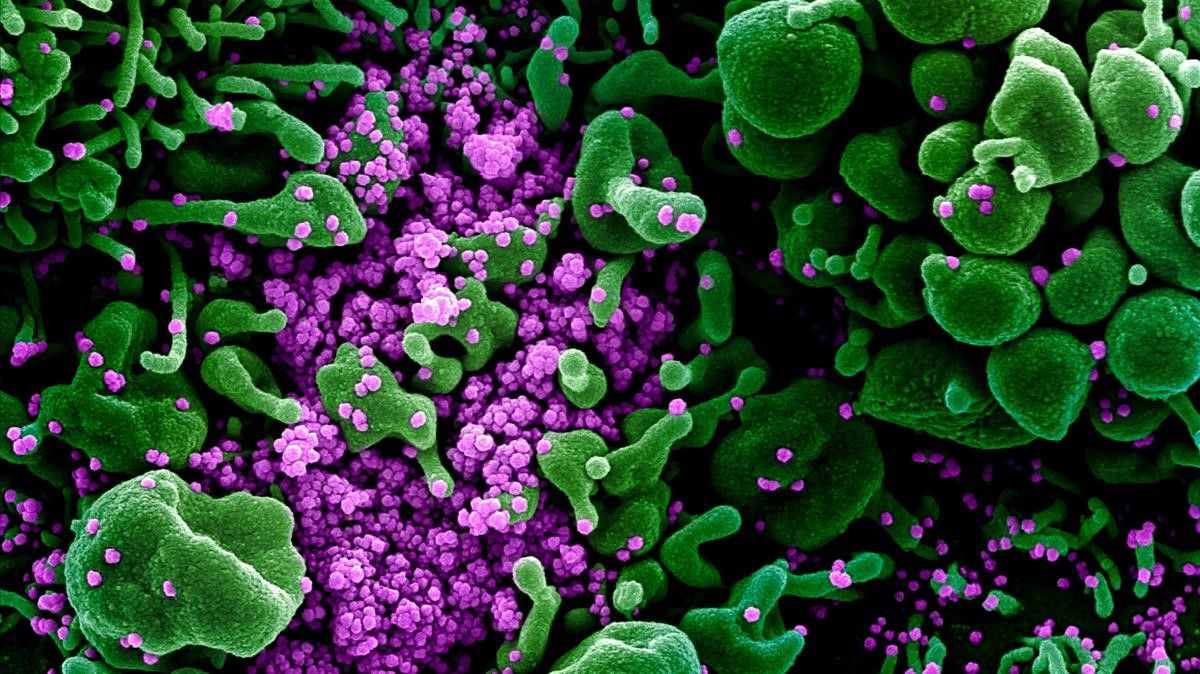 Micrografia electronica de barrido coloreada de una celula apoptotica  en verde  muy infectada con particulas del virus SARS-COV-2  en color purpura  aislada de una muestra de paciente  capturada y mejorada por Centro de Investigacion Integrada del Instituto estadounidense de Alergia y Enfermedades Infecciosas (NIAID)  en Hamilton   Montana (Estados Unidos de America)  a 13 de febrero de 2020   CORONAVIRUS COVID-19 ESTADO DE ALARMA PANDEMIA LABORATORIO NIAID   NIAID  (Foto de ARCHIVO)   virus  coronavirus  covid19 covid 19 generico recurso       13 02 2020