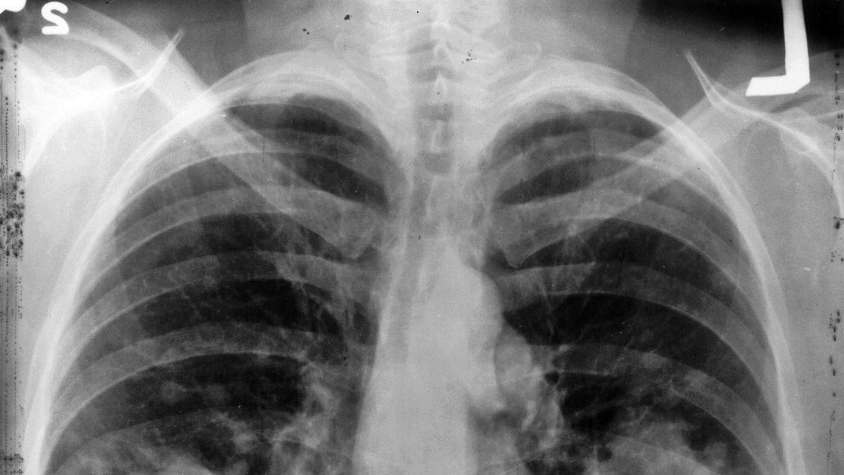 El cáncer de pulmón causó 2023 más de 22.700 fallecimientos.