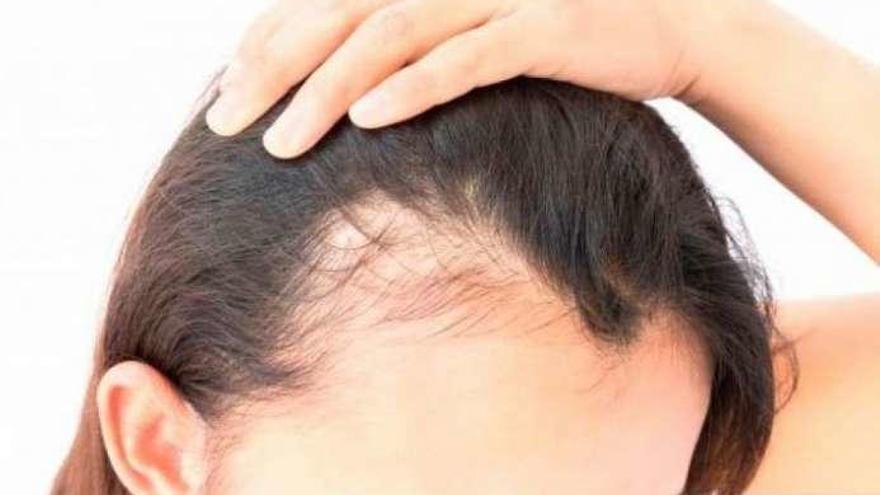 La alopecia femenina afecta a un gran número de mujeres. // Cedida