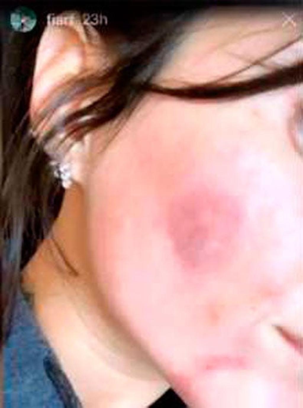 Fiama ('LIDLT') mostrando moratones en su rostro