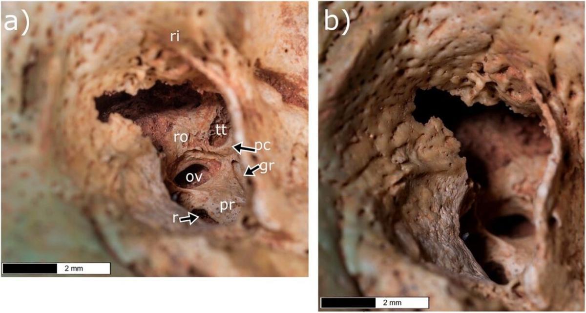 Operacion para la otitis ya en la Edad Media