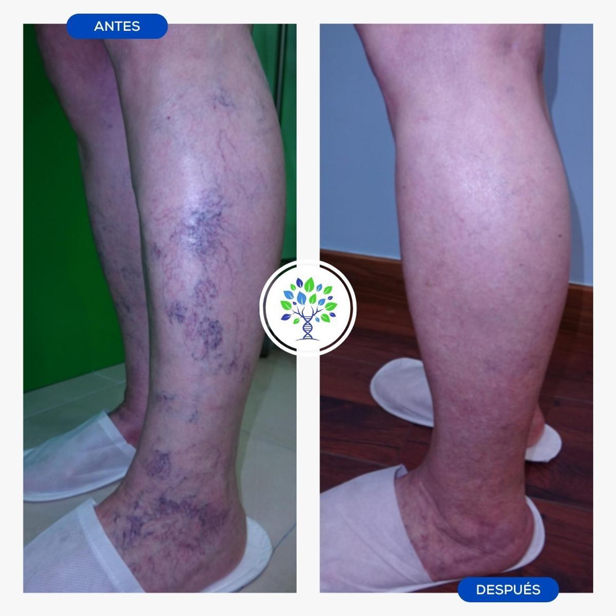 Antes y después del tratamiento realizado por el doctor Oyola.