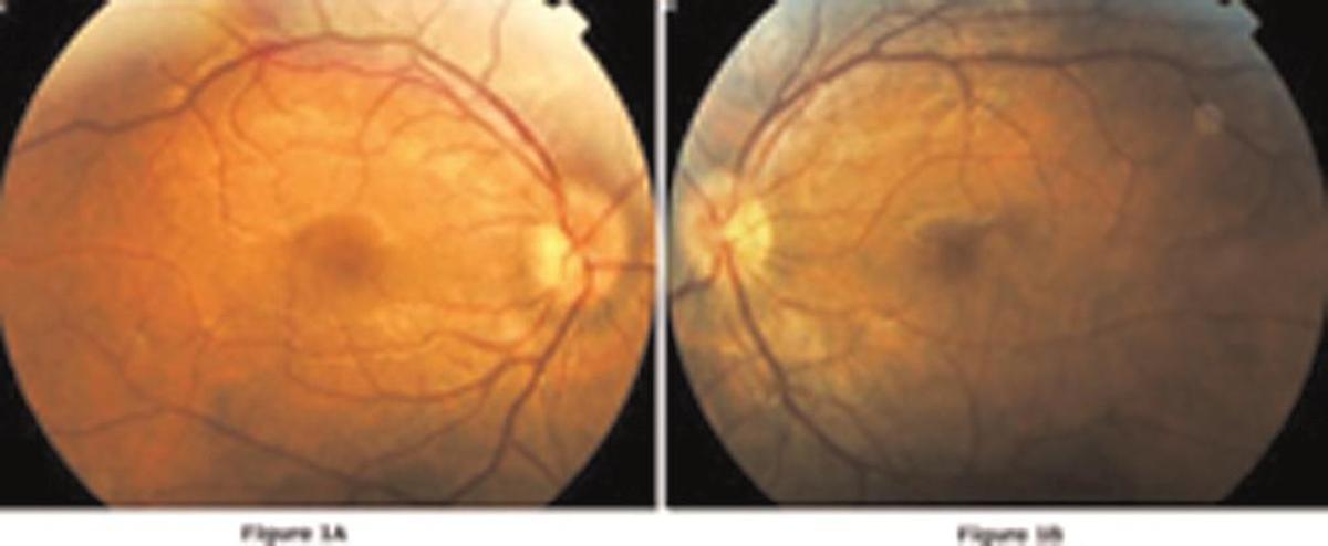 Fundus of a patient with Behçet's disease