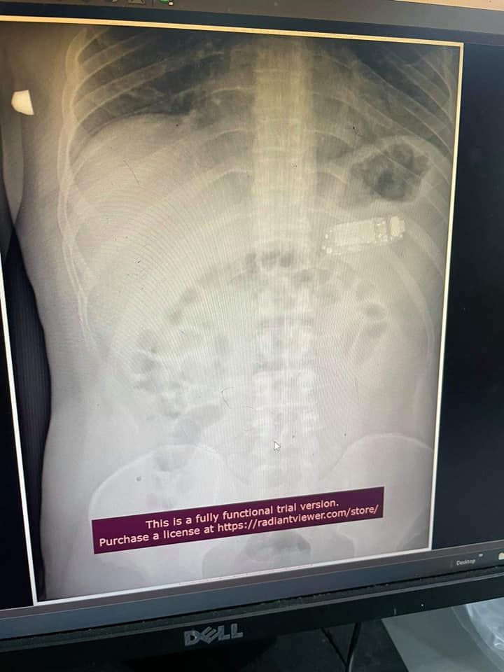 La radiografía donde se aprecia el teléfono dentro del estómago del paciente