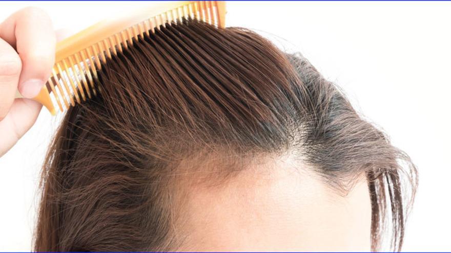 Alopecia femenina: claves para un tratamiento de éxito