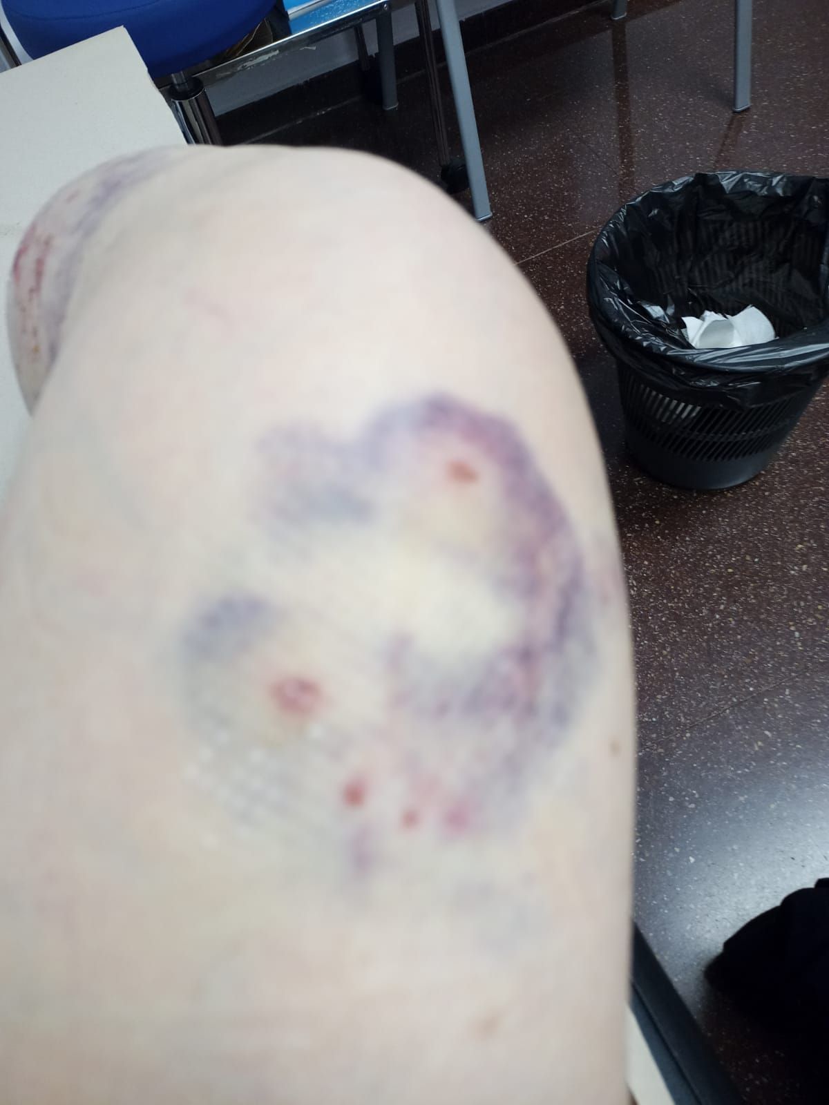 Las heridas causadas por los pitbulls en la pierna de la víctima, dos días después del ataque.