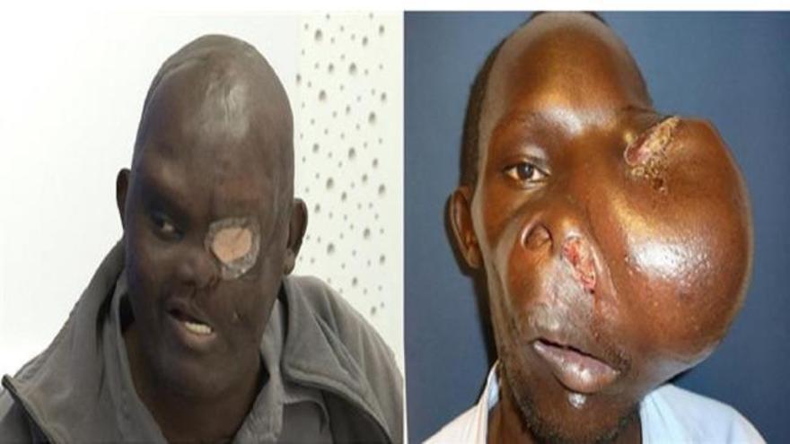 Extirpan un tumor craneal gigante a un joven keniano