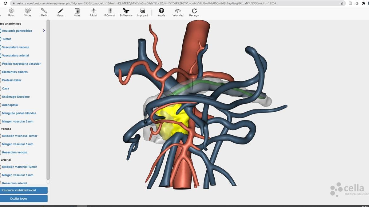 Un estudio investiga estrategias de tratamiento que faciliten la cirugía en cáncer de páncreas avanzado