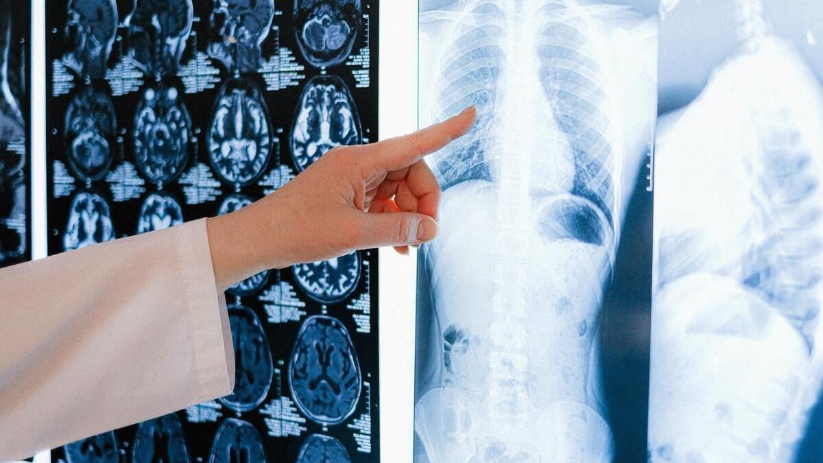 Madrid apoya el cribado de cáncer de pulmón