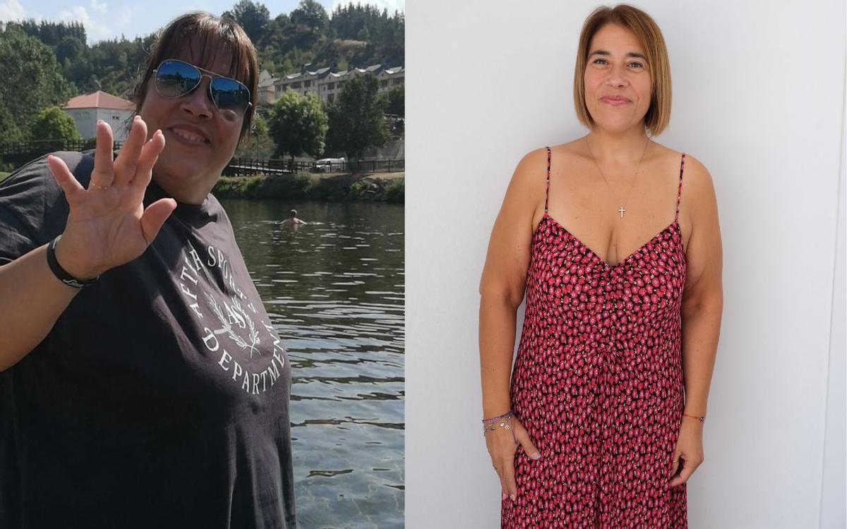 El antes y después de merche, operada de cirugía bariátrica en ilahy.