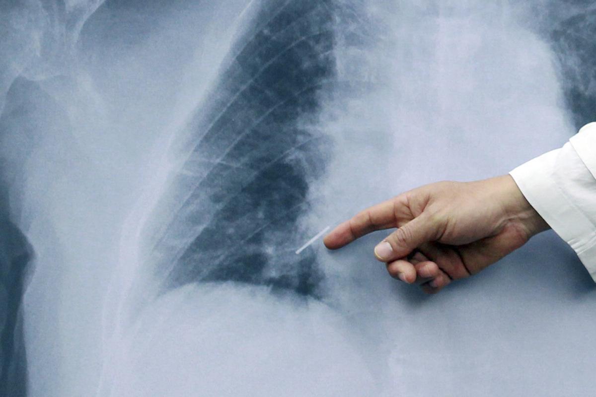 Un médico señala un pulmón en una radiografía.