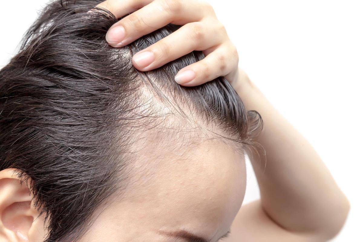 Bald man or woman worry about his or her less hairline on white background isolated
