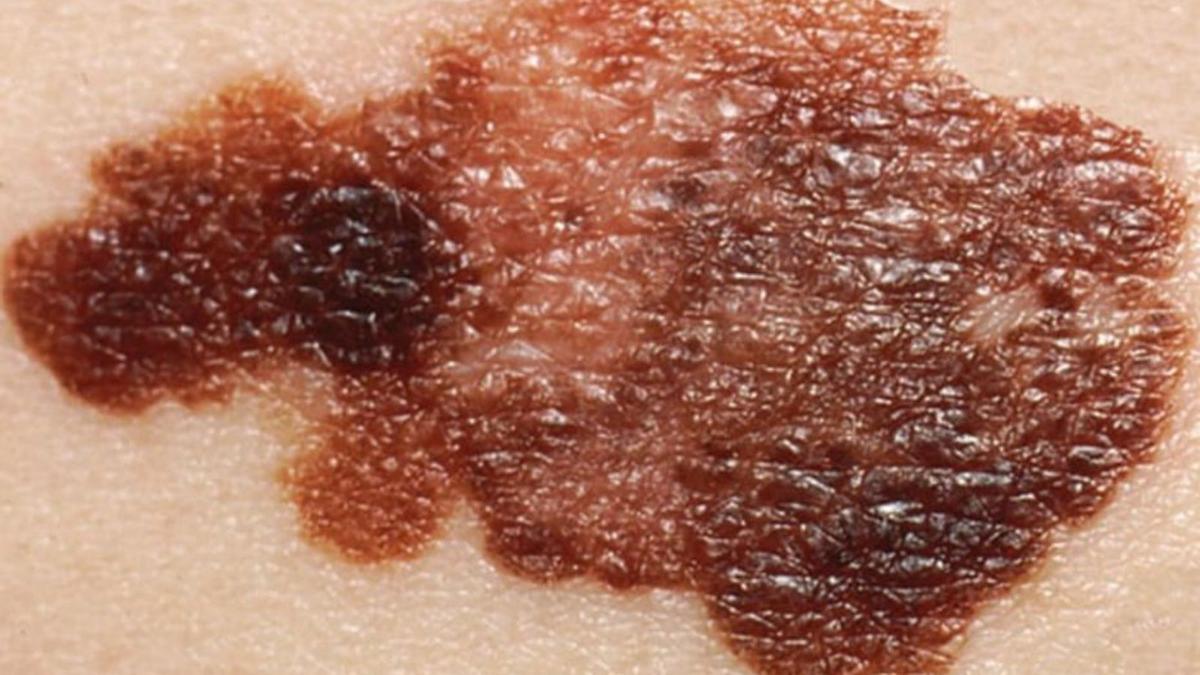 Imatge d’un cas de càncer de pell. | DIARI DE GIRONA