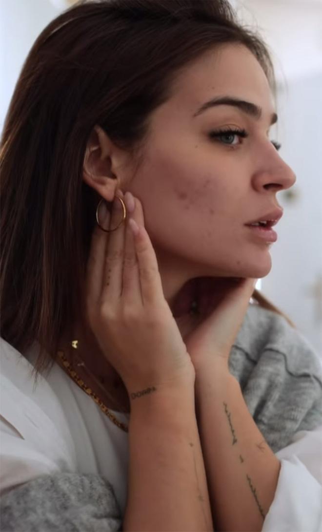 Laura Escanes muestra sus marcas en el rostro sin maquillaje