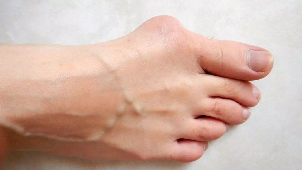 ¿Por qué se deforman los pies? ¿qué son, cómo se curan y por qué se producen los juanetes?