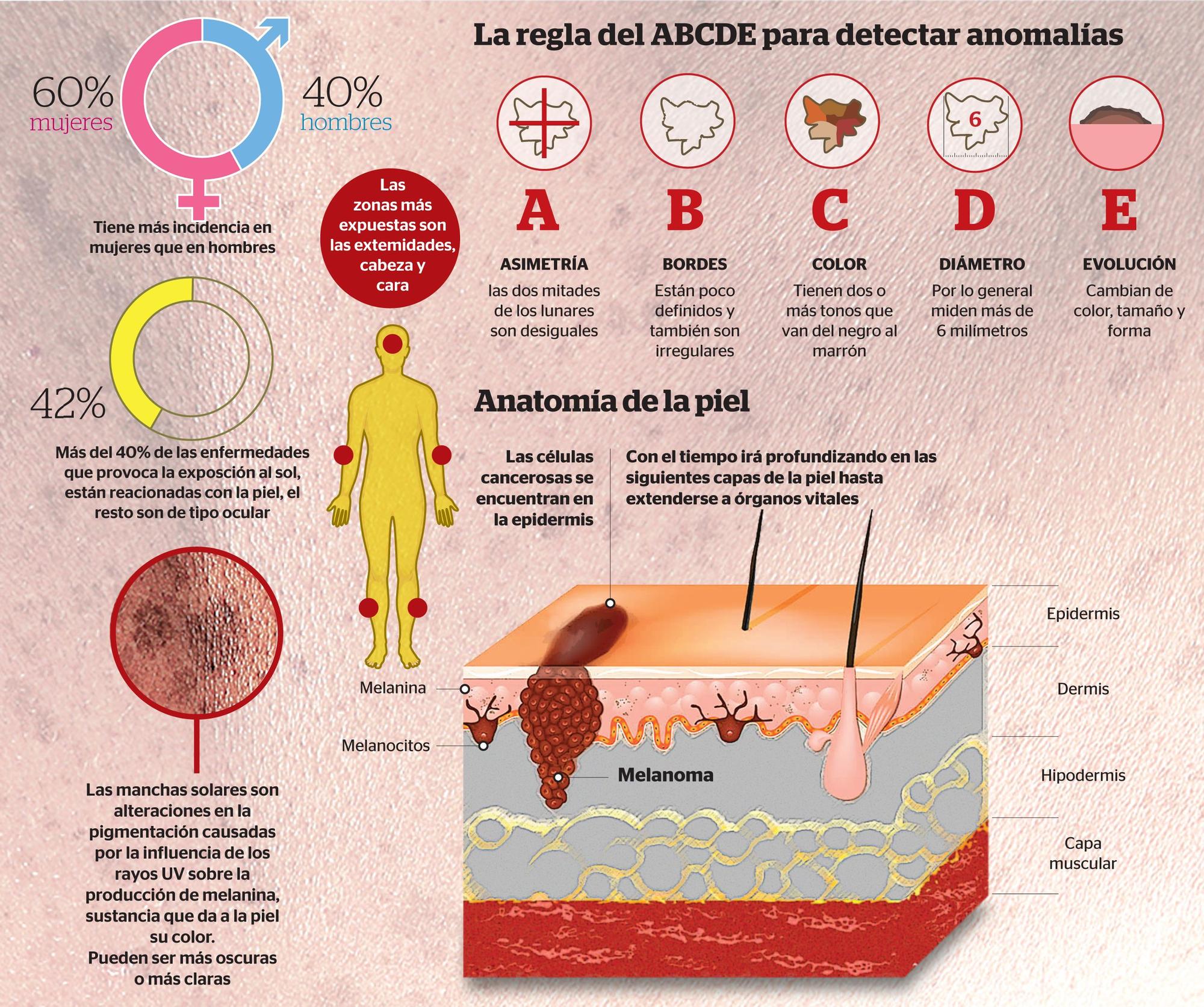 La regla del ABCDE para detectar anomalías