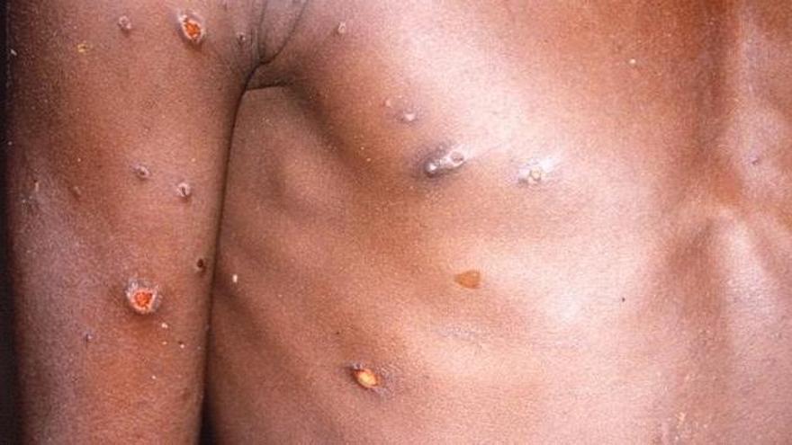 La OMS alerta del riesgo de transmisión comunitaria de mpox, anteriormente conocida como viruela del mono