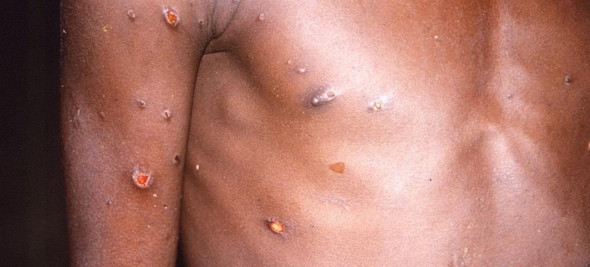 La OMS alerta del riesgo de transmisión comunitaria de mpox a menos que se contengan rápidamente los brotes existentes.