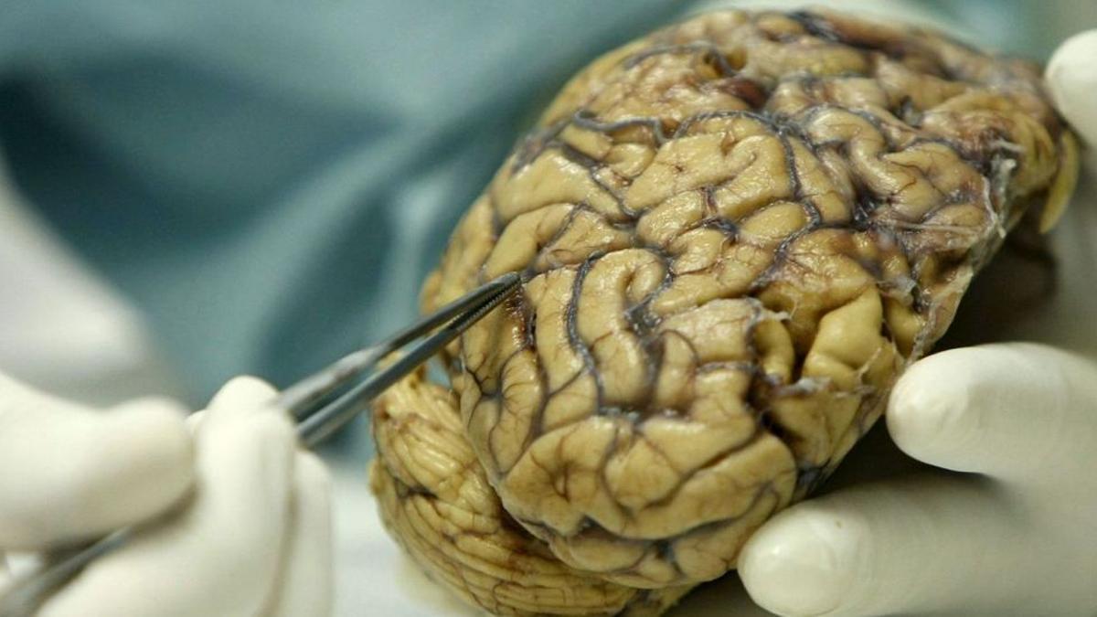 Un cerebro humano enfermo de alzhéimer.