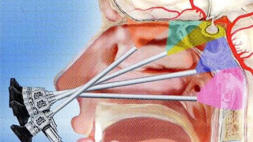 Cirujanos vigueses aplican una técnica para operar tumores cerebrales por la nariz