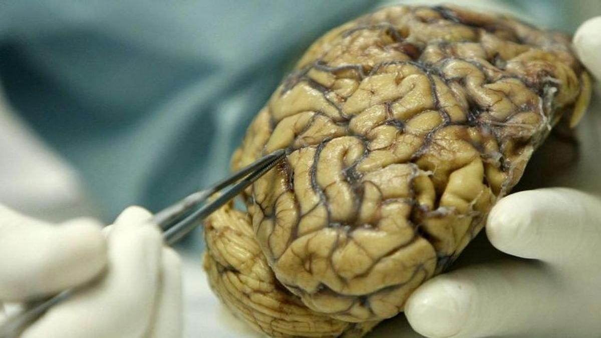 Un cerebro enfermo de alzhéimer.