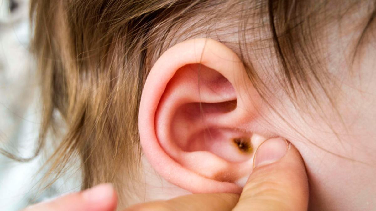 Otitis: Causas y prevención de los problemas auditivos para los más pequeños este verano