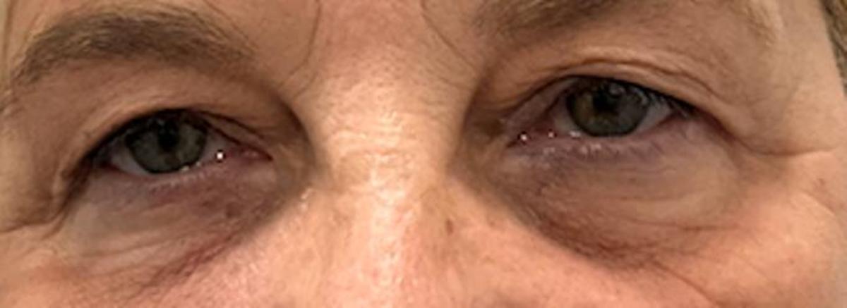 Ojos de una paciente antes de realizarse una blefaroplastia.