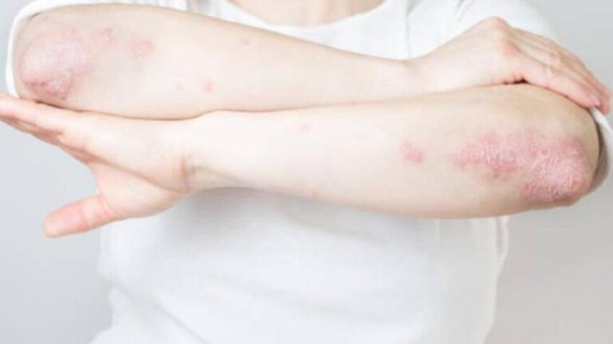 La psoriasis tiene alto impacto psicológico.