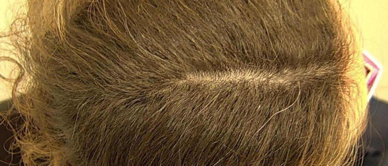 Laura muestra su cuero cabelludo antes y después del tratamiento contra la alopecia areata.