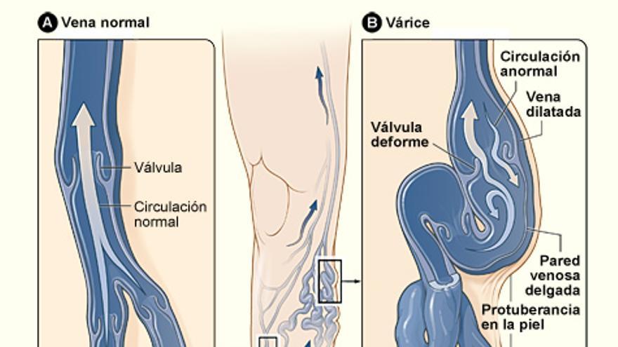Breve de soporte de varicosidad vulvar y prolapso  